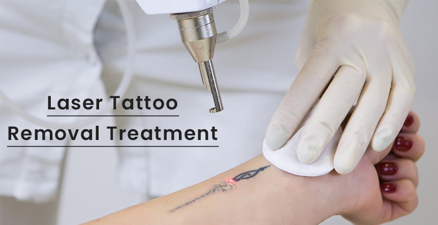 Tattoo Removal in Ahmedabad